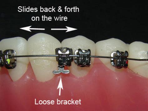 how to repair a broken metal bracket|loose bracket still on wire.